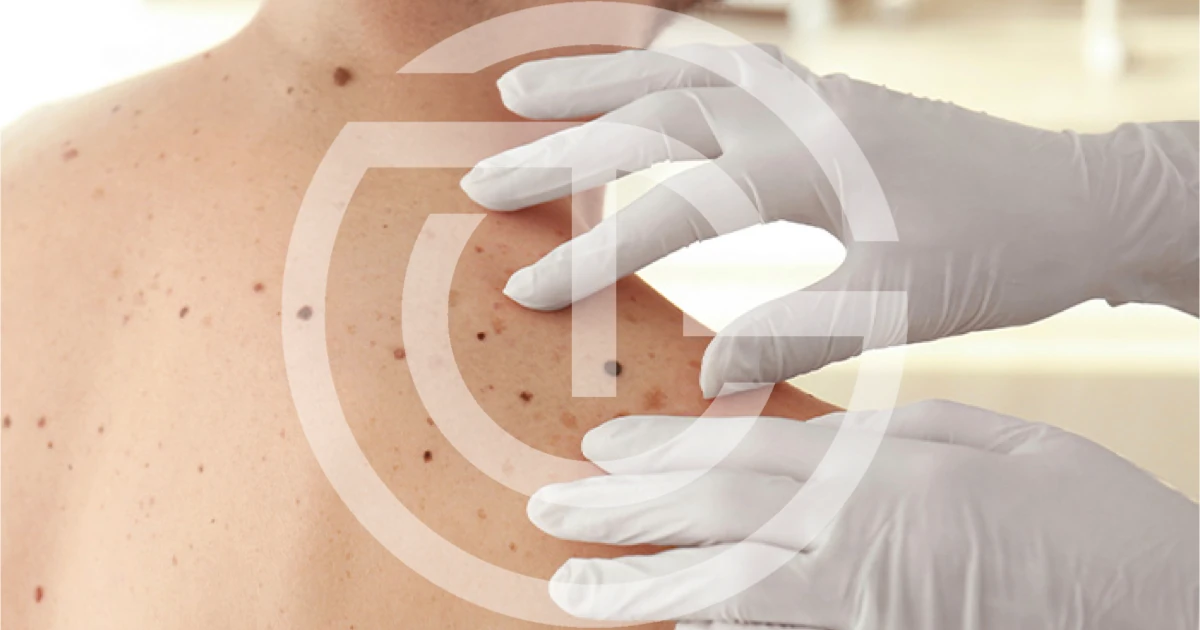 mappatura nei giulia tadiotto cicogna dermatologo dermatologa padova conegliano vittorio veneto