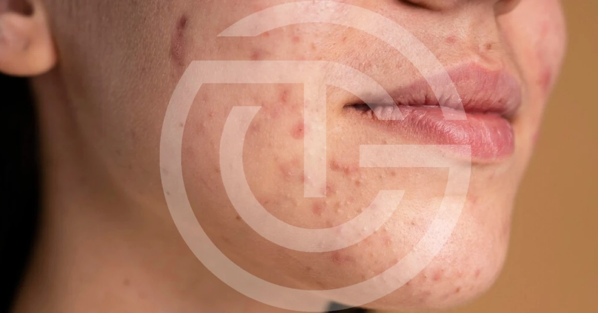acne giulia tadiotto cicogna dermatologo dermatologa medicina estetica laser padova treviso conegliano vittorio veneto