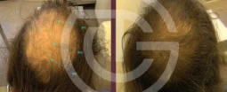 alopecia androgenetica giulia tadiotto cicogna dermatologo dermatologa medicina estetica laser padova treviso conegliano vittorio veneto