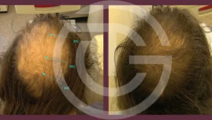 alopecia androgenetica giulia tadiotto cicogna dermatologo dermatologa medicina estetica laser padova treviso conegliano vittorio veneto