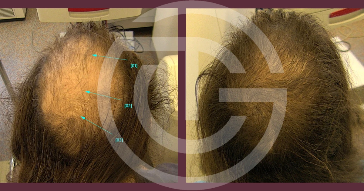 alopecia androgenetica giulia tadiotto cicogna dermatologo dermatologa medicina estetica laser padova treviso conegliano vittorio veneto